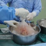 دختر ۲۰ ساله کنگانی به ۳ بیمار نیازمند به عضو حیاتی دوباره بخشید